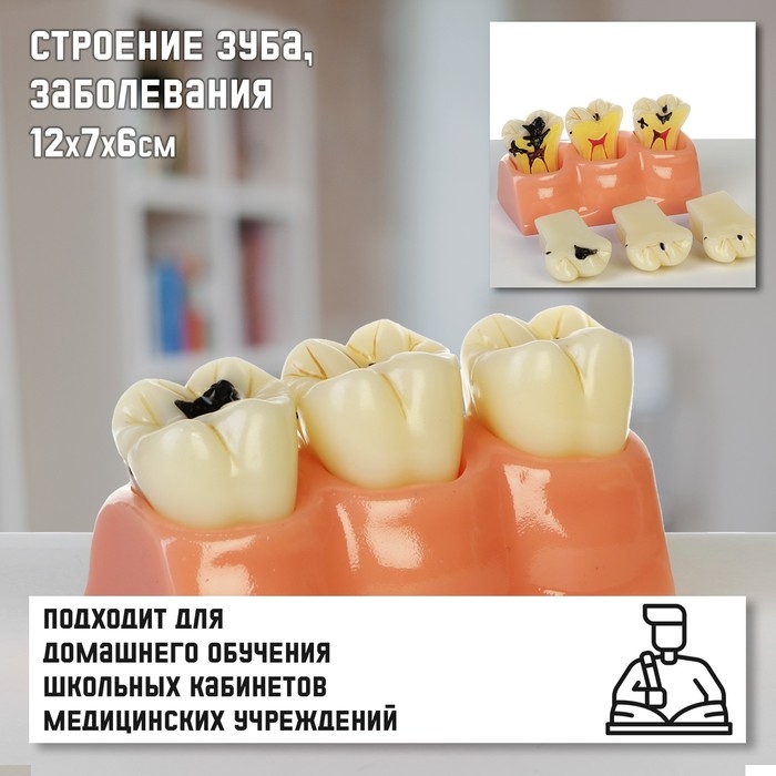 Макет  Макет "Строение зуба, заболевания", 12*7*6см