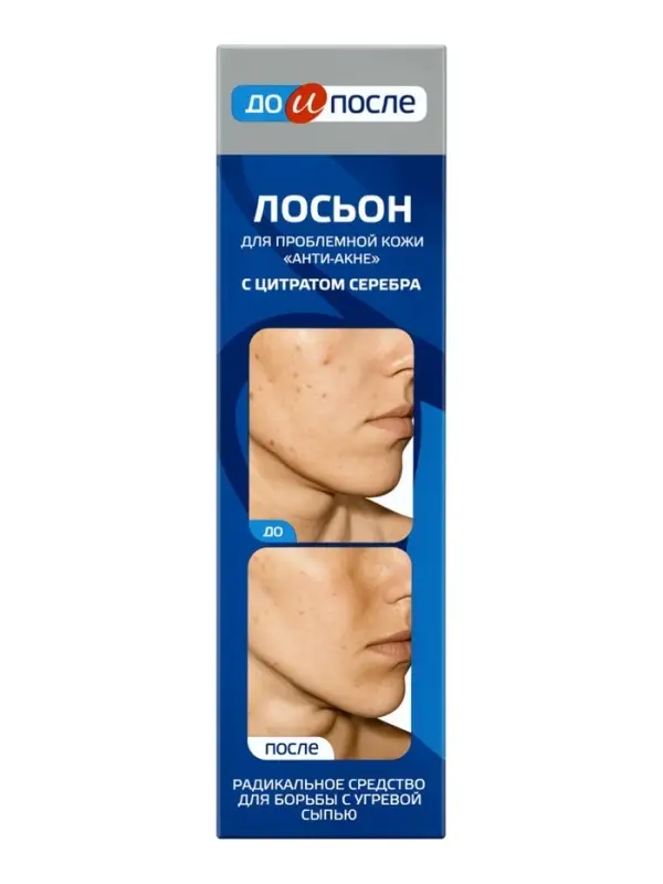Лосьон &laquo;До и После&raquo; Анти-Акне для проблемной кожи, 200 мл
