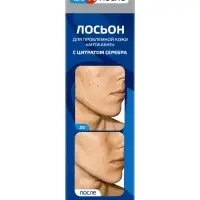 Лосьон &laquo;До и После&raquo; Анти-Акне для проблемной кожи, 200 мл