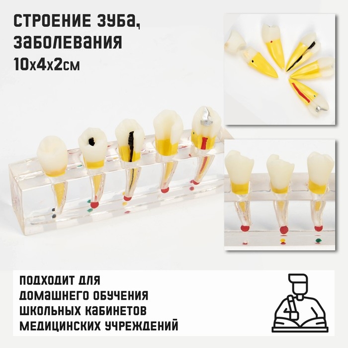 Макет  Макет "Строение зуба, заболевания", 10*4*2см