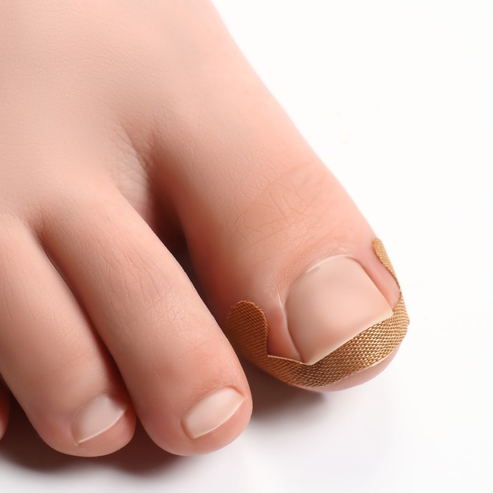 Набор наклеек для коррекции вросших ногтей, 8 шт, 5,2 × 2 см, цвет бежевый