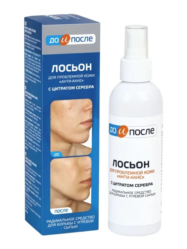Лосьон &laquo;До и После&raquo; Анти-Акне для проблемной кожи, 200 мл